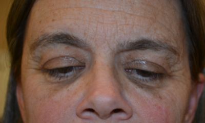after blepharoplasty front view female patient case 25