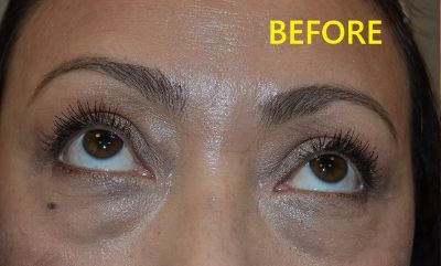 before blepharoplasty front view of female patient case 2740