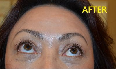 after blepharoplasty front view of female patient case 2740