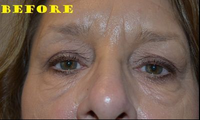 before blepharoplasty front view of female patient 2743