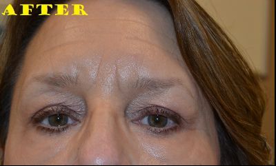 after blepharoplasty front view of female patient case 2743
