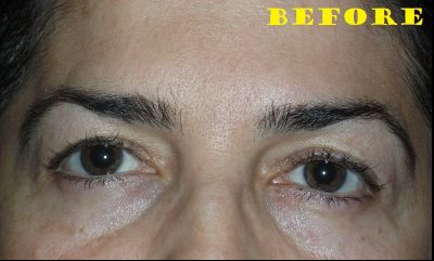 before blepharoplasty front view female patient case 2746