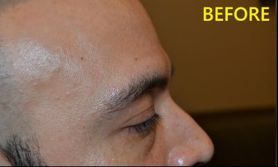 before blepharoplasty right side view male patient case 2749