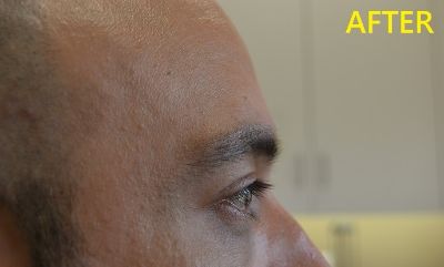after blepharoplasty right side view male patient case 2749