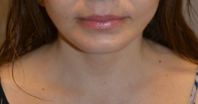 after chin implant front view of patient 1851