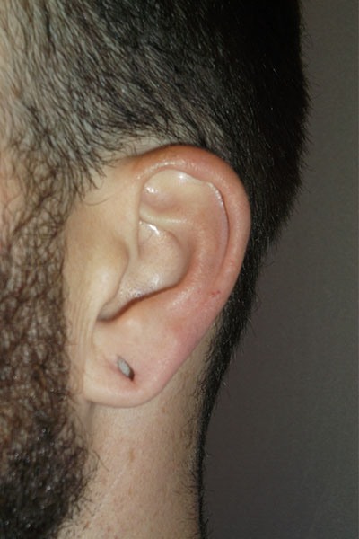 before earlobe repair left angle view patient 1610