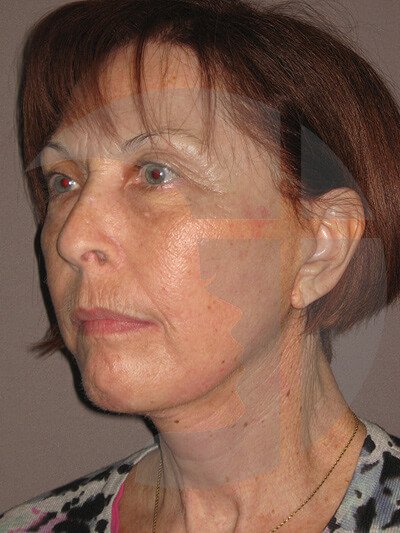 after facelift left angle view of female patient 967