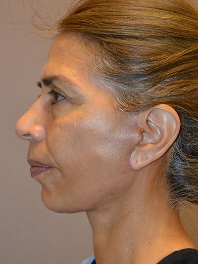 after facelift left side view of female patient 18