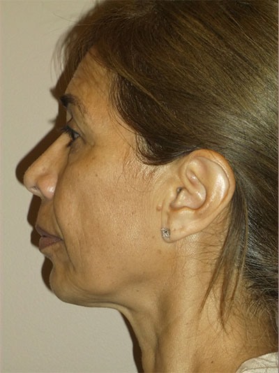 before facelift left side view of female patient 18
