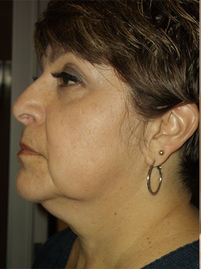 before facelift left angle view of female patient 1638