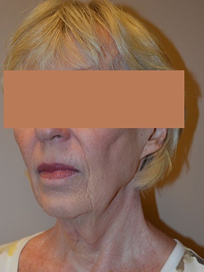 before facelift left angle view of female patient 1642