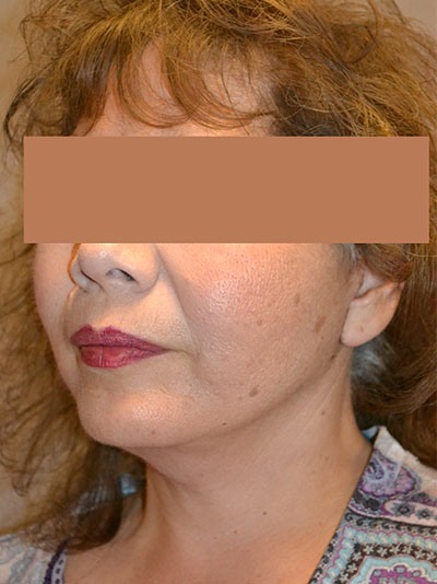 after facelift left angle view of female patient 1645