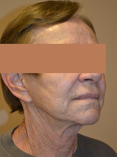 before facelift right angle view of patient 1673