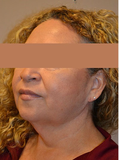 before facelift left angle view of female patient 26