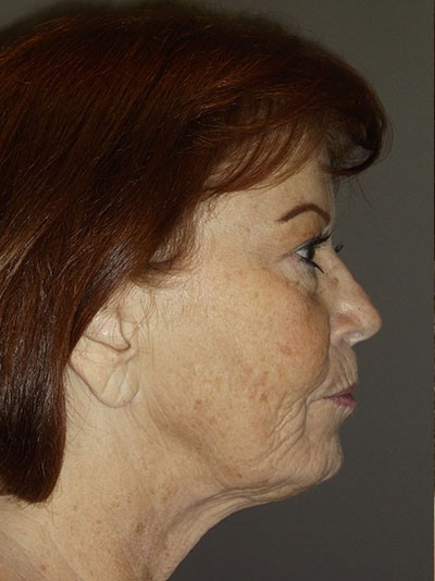 after facelift right side view of female patient 1730
