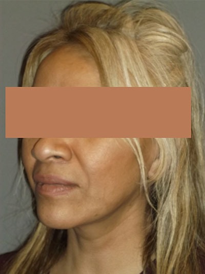 after facelift left angle view of female patient 1745