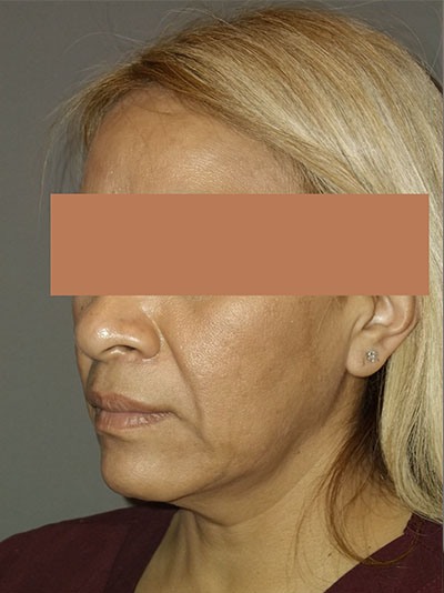 before facelift left angle view of female patient 1745