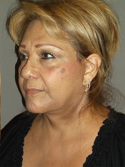 after facelift left angle view of female patient 1866
