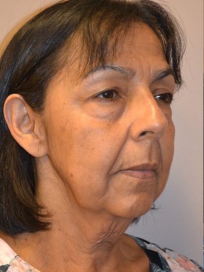 before facelift right angle view female patient case 1908