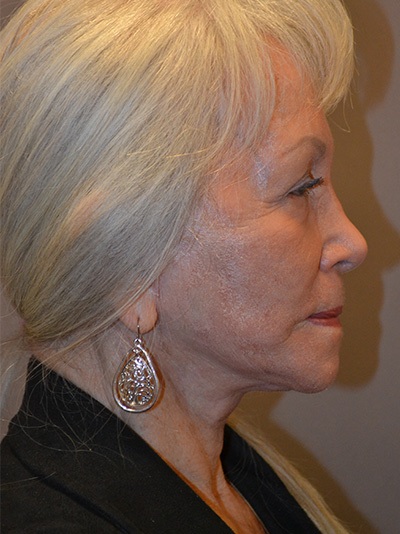 after facelift right side view female patient case 1929