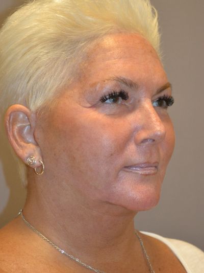 after facelift right angle view female patient case 1976
