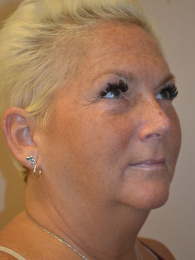 before facelift right angle view female patient case 1976