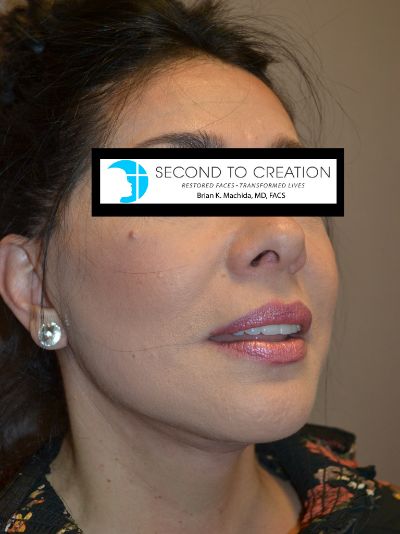 after facelift right angle view female patient case 1987
