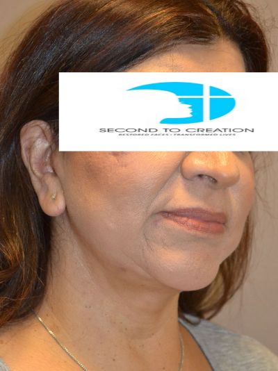after facelift right angle view female patient 43