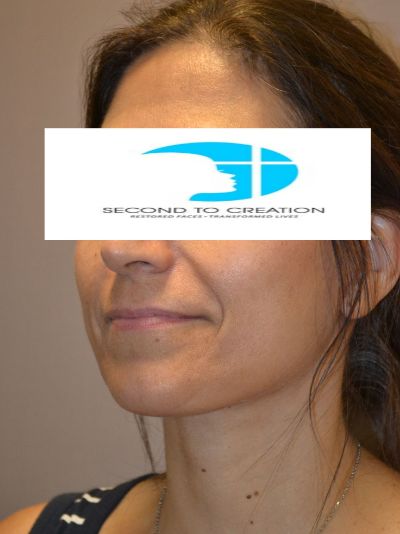 after facelift left angle view female patient case 45