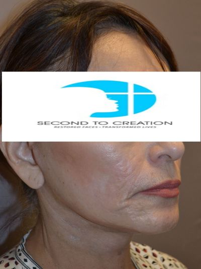 after facelift right angle view female patient case 46