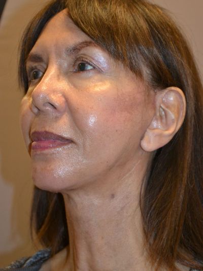 after facelift left angle view female patient case 47