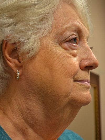 before facelift right view female patient case 49