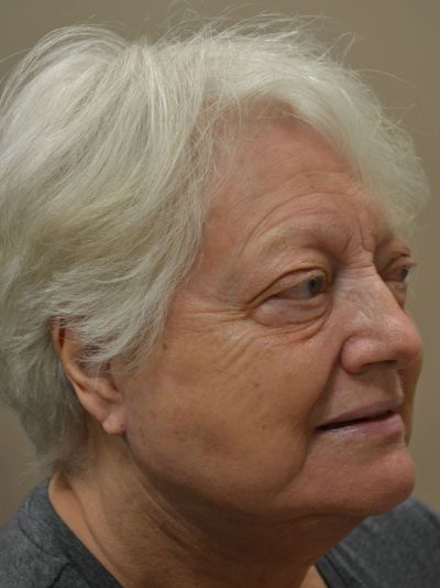 after facelift right angle view female patient case 49