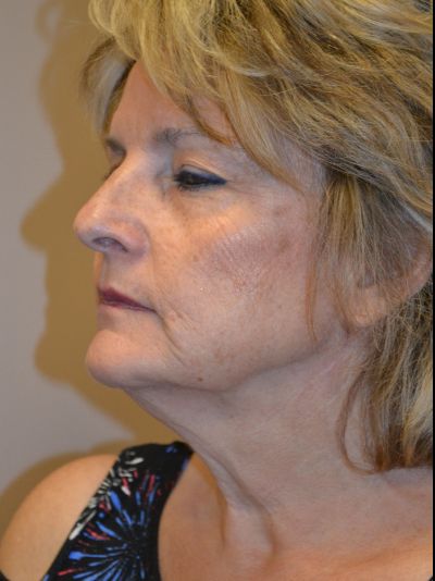 before facelift left angle view female patient case 50