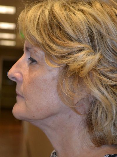 after facelift left view female patient case 50