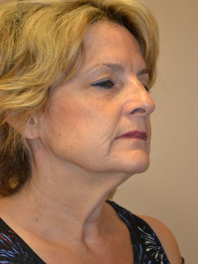 before facelift right angle view female patient case 55