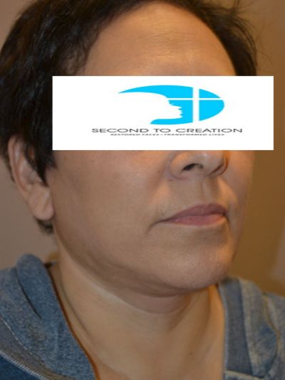 after facelift right angle view female patient case 57