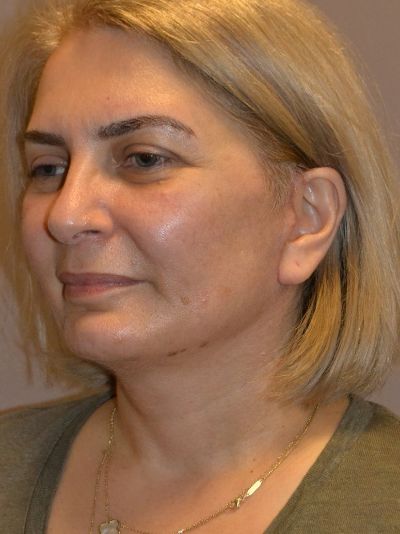 after facelift left angle view female patient case 58