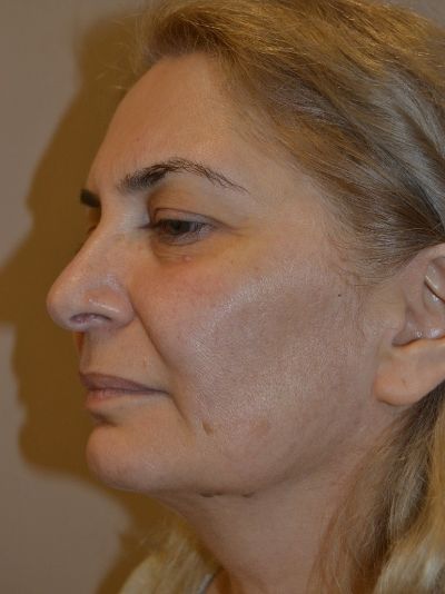 before facelift left view female patient case 58