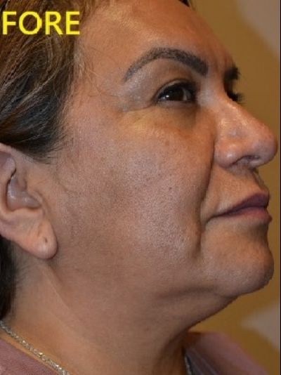 before facelift right side view of female patient case 2683