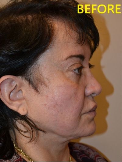 before facelift right side view of female patient case 2686
