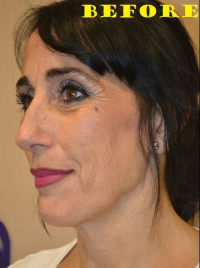 before facelift left angle view of female patient case 2690