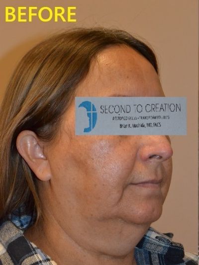 before facelift right angle view of female patient case 2696