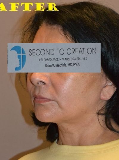 after facelift left angle view of female patient case 2702