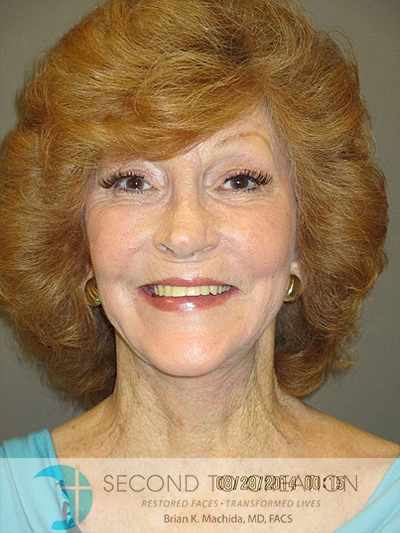 after facelift front view of female patient 766