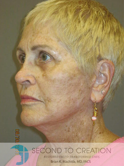 after facelift left angle view of female patient 984
