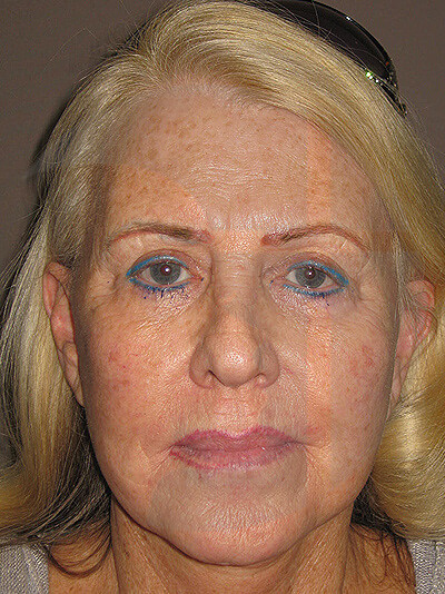 before fractional laser front view of female patient 1034