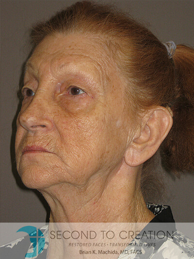 before fractional laser left angle view of female patient 1041