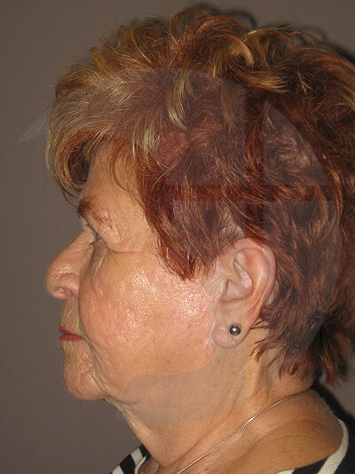 before fractional laser left side view of female patient 1046