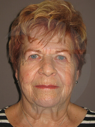 before fractional laser front view of female patient 1046